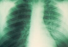What Is Pneumonic Plague? Symptoms of the Lung Infection – Tampascoop